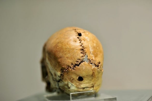 The skull, on which the first brain surgery was performed, is of great importance in terms of medical history and is exhibited in the Aksaray Museum.