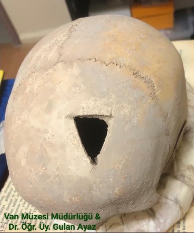 В Турции нашли трепанированный череп возрастом 3200 лет