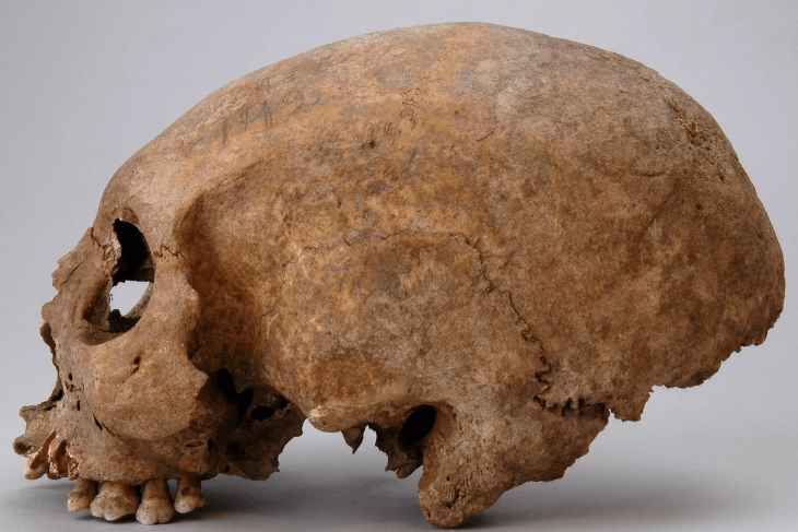 Artificially modified skull from the female individual in grave 192 from Havor, Hablingbo parish, Gotland. © SHM/Johnny Karlsson 2008-11-05 (CC BY 2.5 SE)