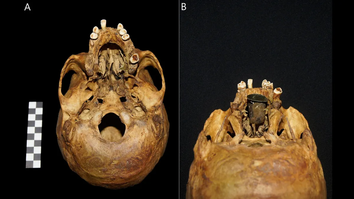 The skull of the man found in Poland from behind. On the left, the absence of a hard palate can be seen. The photograph on the right shows how the gold prosthesis was fitted.