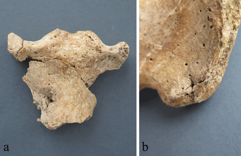Puncture wound on the anterior side of the manubrium, SK 4; (B) puncture wound on the posterior side of the right ilium, SK 5. These were not victims of plague or famine, but men who had lived—and died—by the sword. Credit: PLoS One (2025)