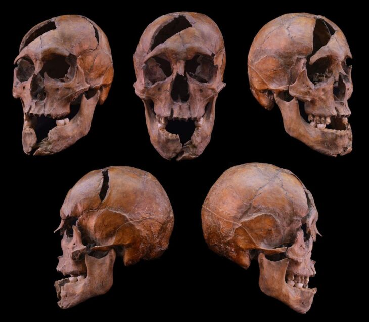 The skull of the 13th-century individual uncovered in the Dominican monastery on Margaret Island in Budapest, examined in the ELTE-led investigation. Credit: Eötvös Loránd University (ELTE)