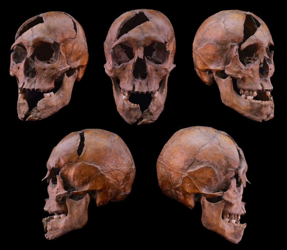 The skull of the 13th-century individual uncovered in the Dominican monastery on Margaret Island in Budapest, examined in the ELTE-led investigation. Credit: Eötvös Loránd University (ELTE)