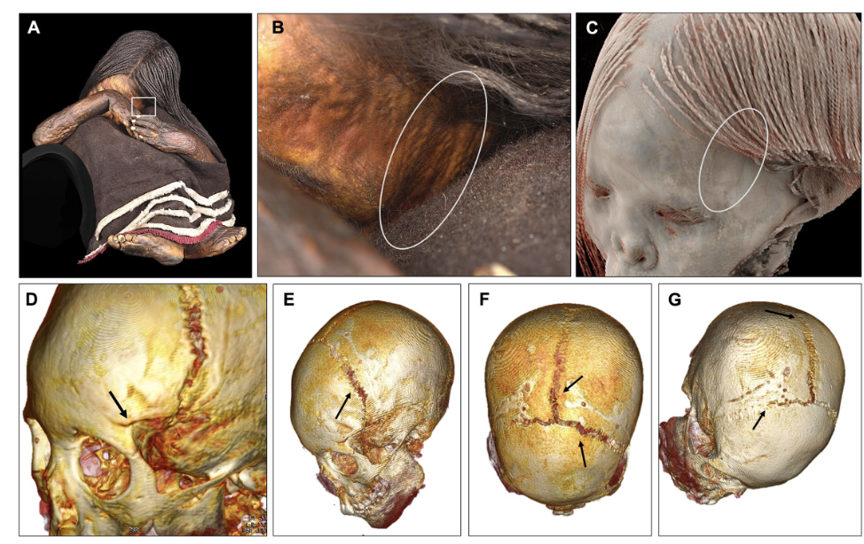 Skin and cranial injuries in the El Plomo child. The images show the forehead lesion, underlying frontal fracture, and separation of the coronal and sagittal sutures revealed by CT scans. Credit: Museo Nacional de Historia Natural, Chile / Centro Nacional de Conservación y Restauración (CNCR), P. Monteverde, 2023.