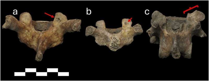 Examples of facet joint lesions on the vertebrae of three young individuals, including a 10-year-old and two approximately 17-year-olds. Credit: Tutwiler & Schats, 2026.